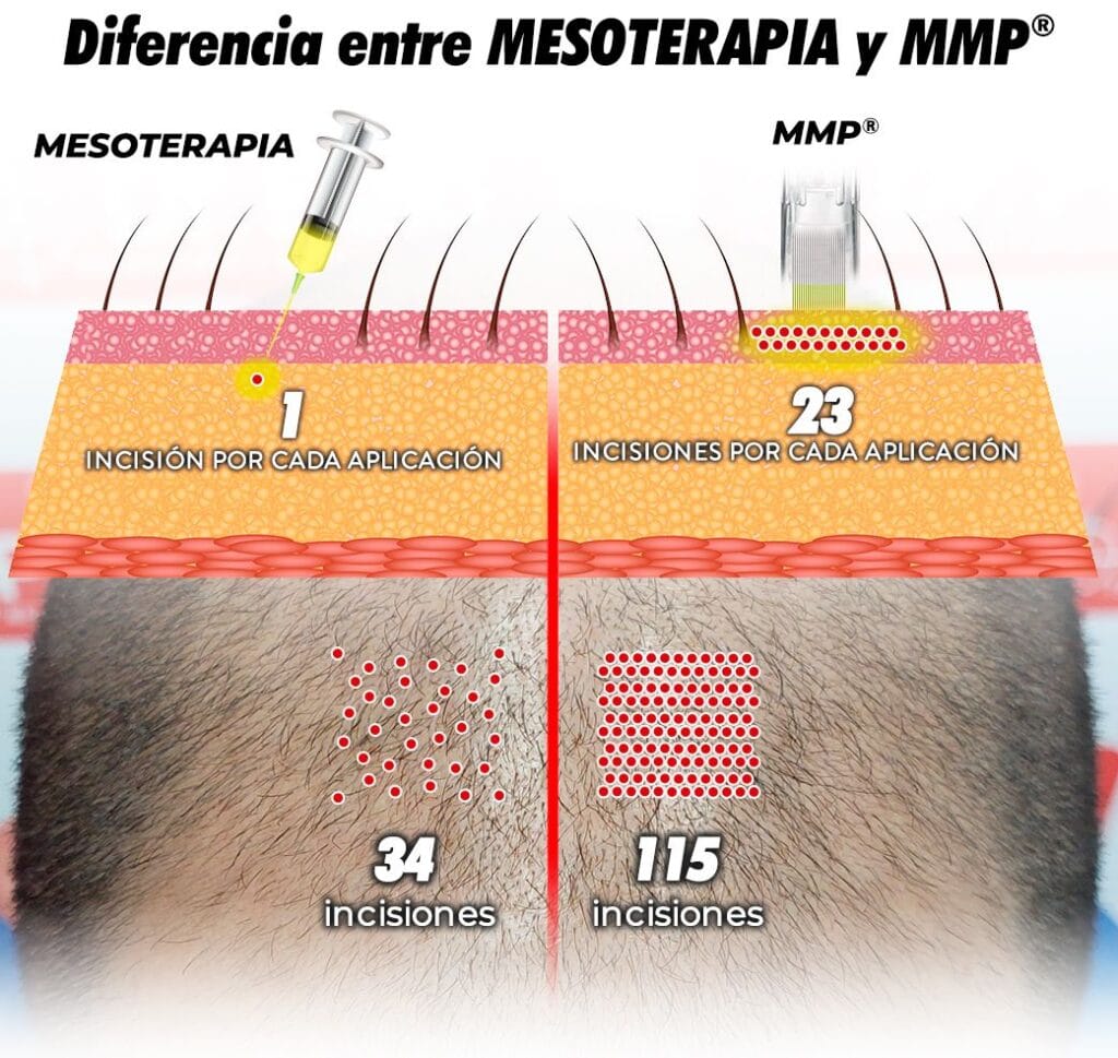MMP Capilar- Microinfusión de medicamentos en la piel - Clínicas Dr.Pelo