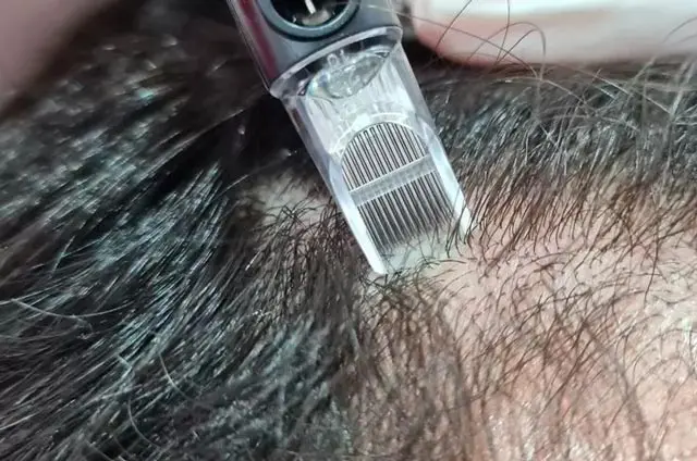 clinica medicina capilar madrid