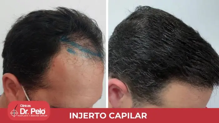 clinica injerto capilar dr pelo
