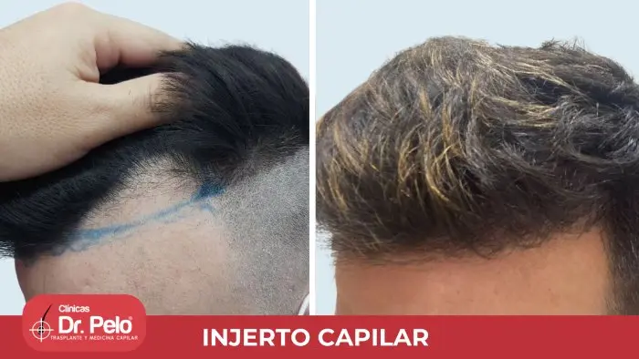 clinica injerto capilar