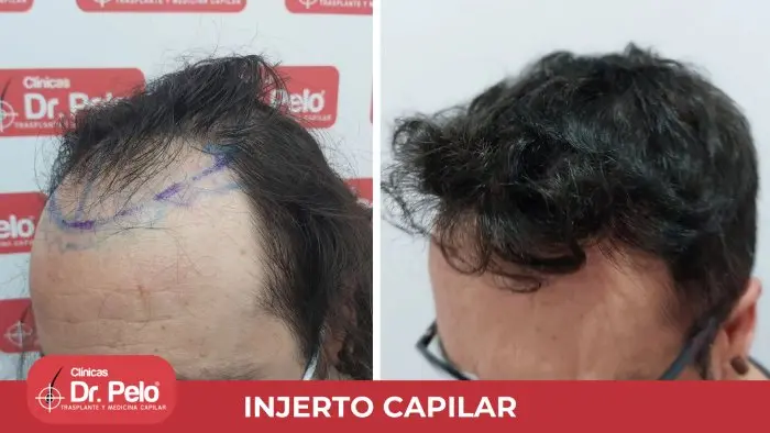 evolucion injerto capilar