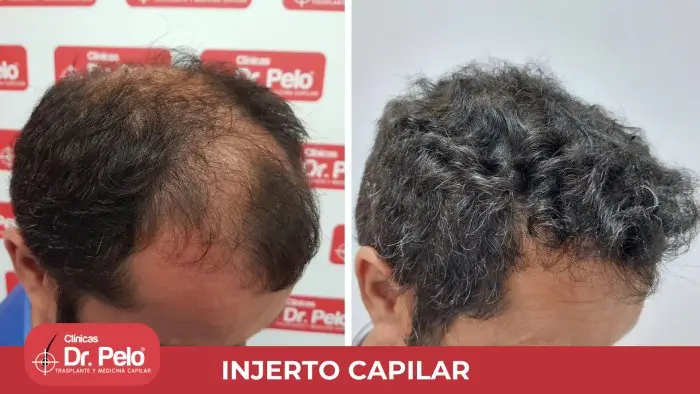 injerto capilar antes despues