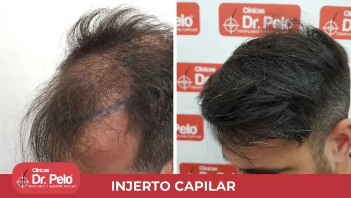 injerto capilar precio