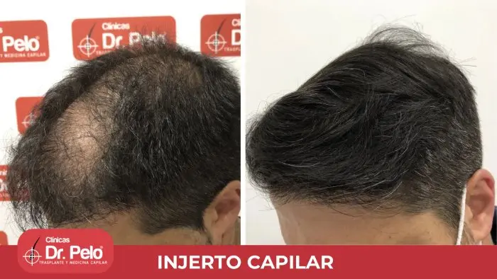 injerto capilar precios españa