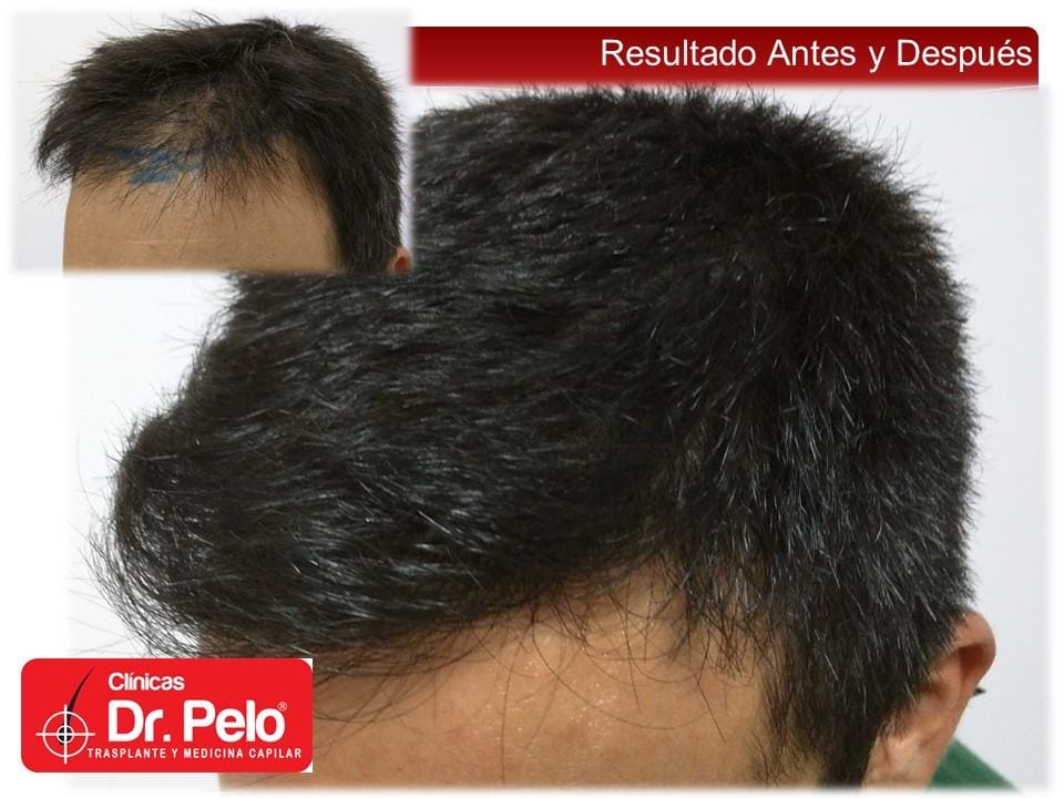 reconstrucción capilar