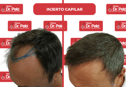 injerto capilar resultados