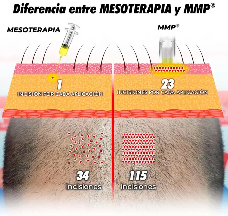 mmp capilar en cordoba