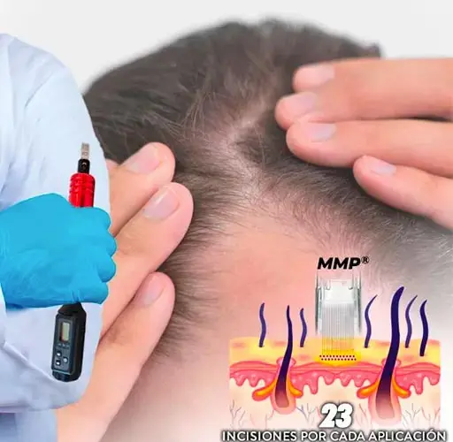 mesoterapia capilar precios Badajoz