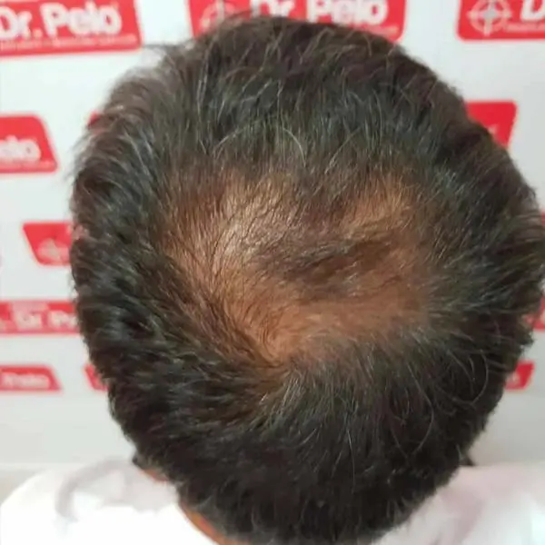 antes y despues injerto de pelo