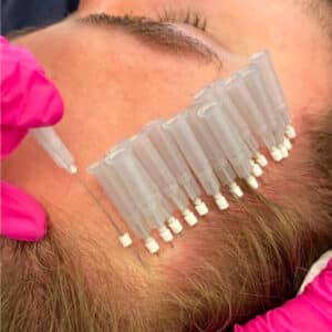 Hilos PDO para Alopecia Androgenética