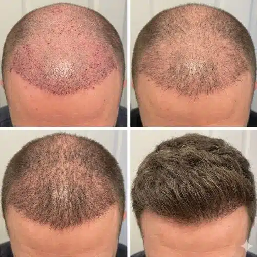 Cronología injerto capilar: Resultados mes a mes