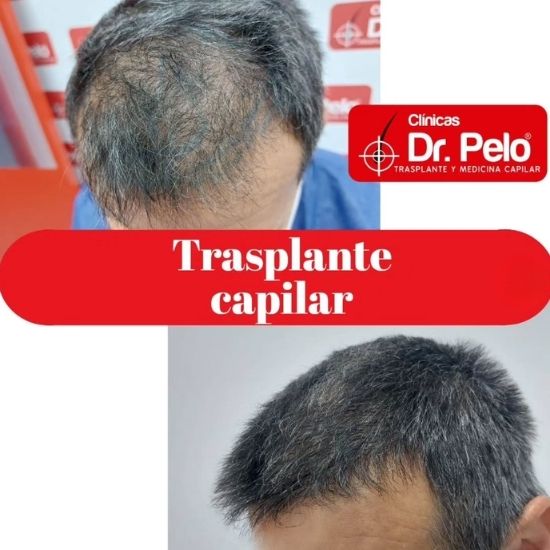 transplante capilar dr pelo (1)