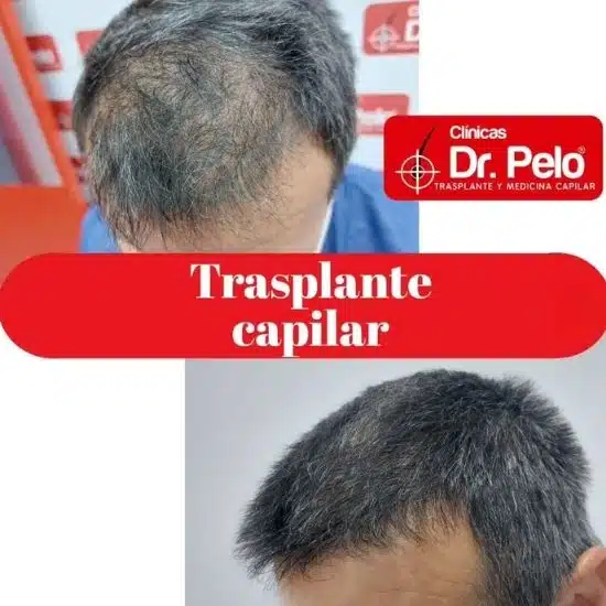 transplante capilar dr pelo (1)