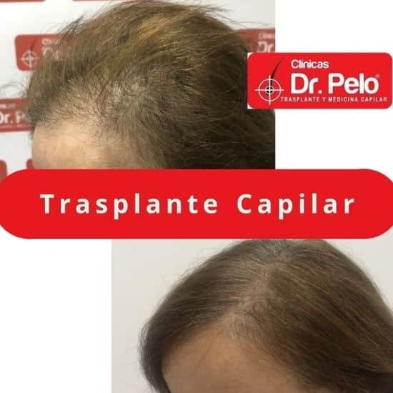 transplante capilar dr pelo (2)