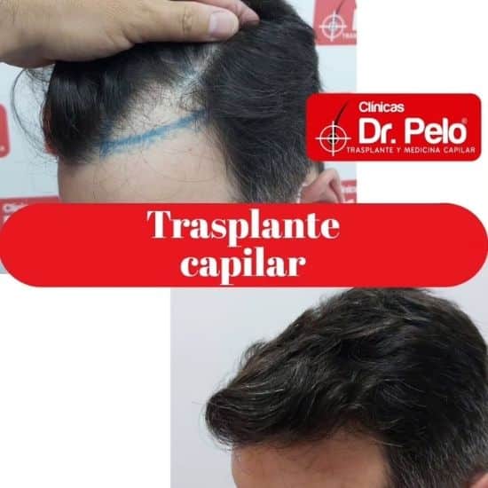 transplante capilar dr pelo (3)