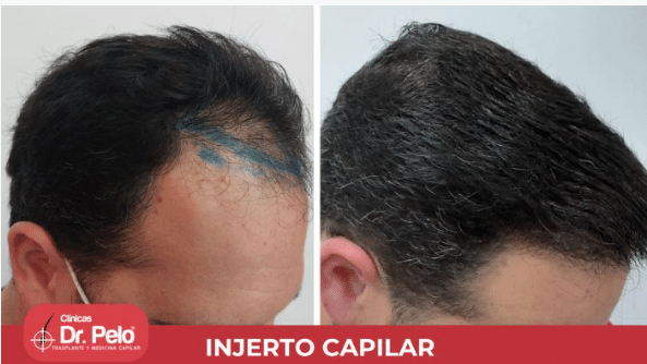 Antes y después de injerto capilar