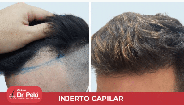 Antes y después de injerto capilar