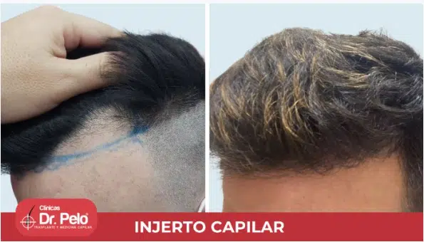 Antes y después de injerto capilar
