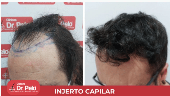 Antes y después de injerto capilar