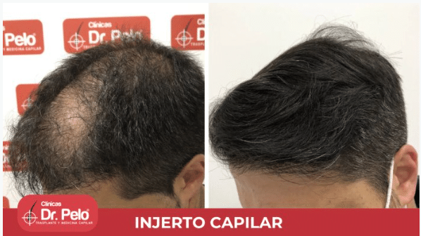 Antes y después de injerto capilar