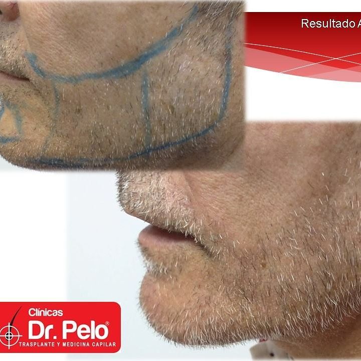 injerto-barba (1)
