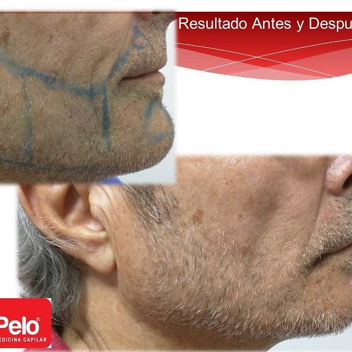 injerto-barba (2)