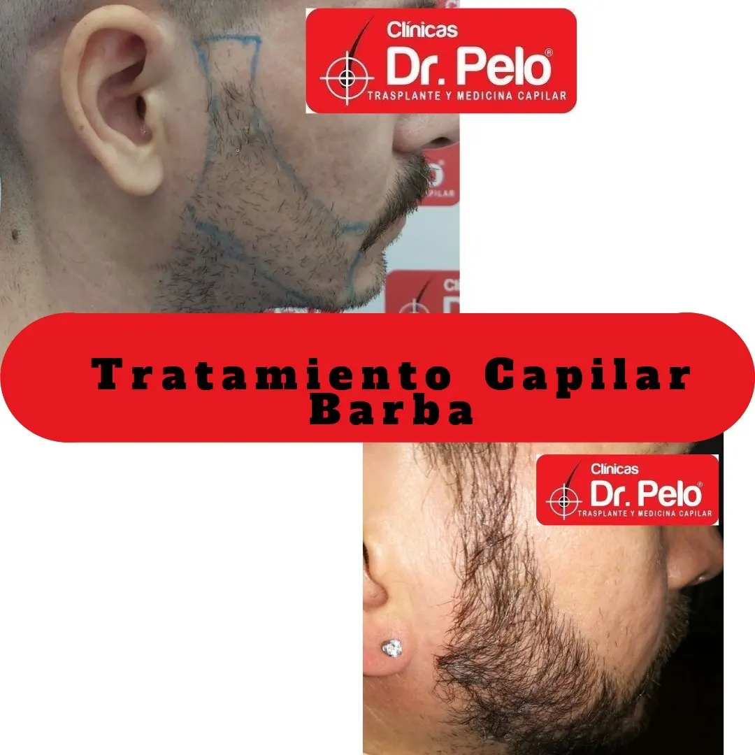 injerto-barba (3)