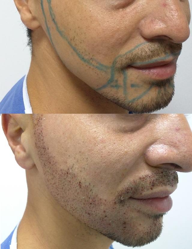 injerto de barba en clinicas dr pelo