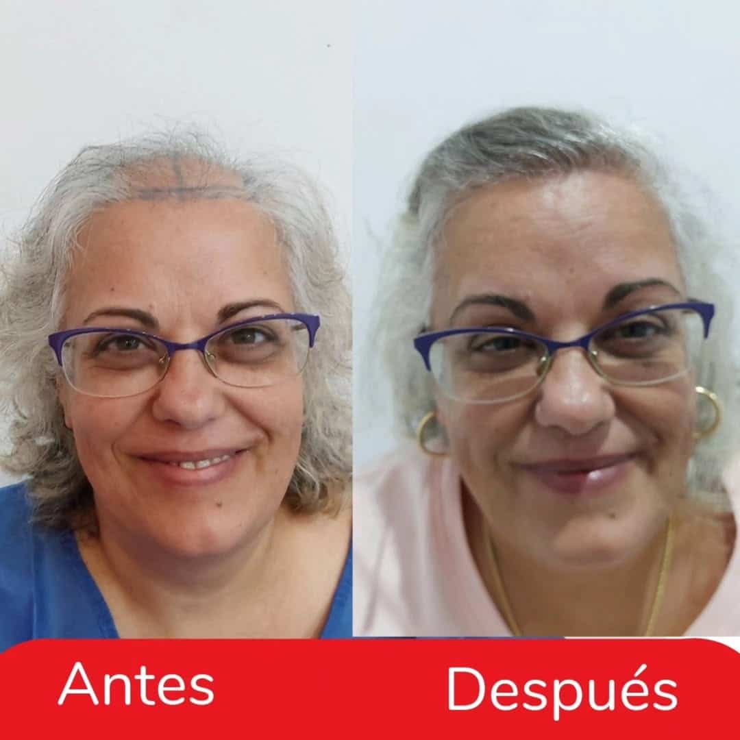 INJERTO CAPILAR MUJER (1)
