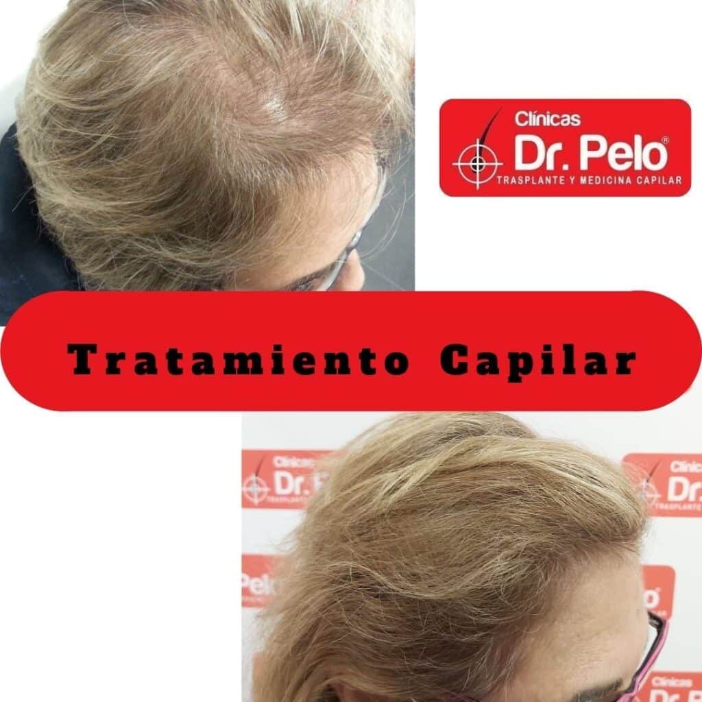 TRATAMIENTO-CAPILAR-MUJER