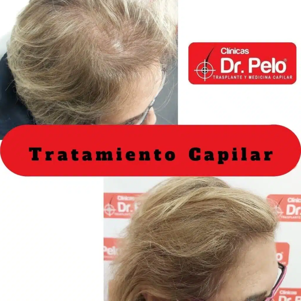 TRATAMIENTO-CAPILAR-MUJER