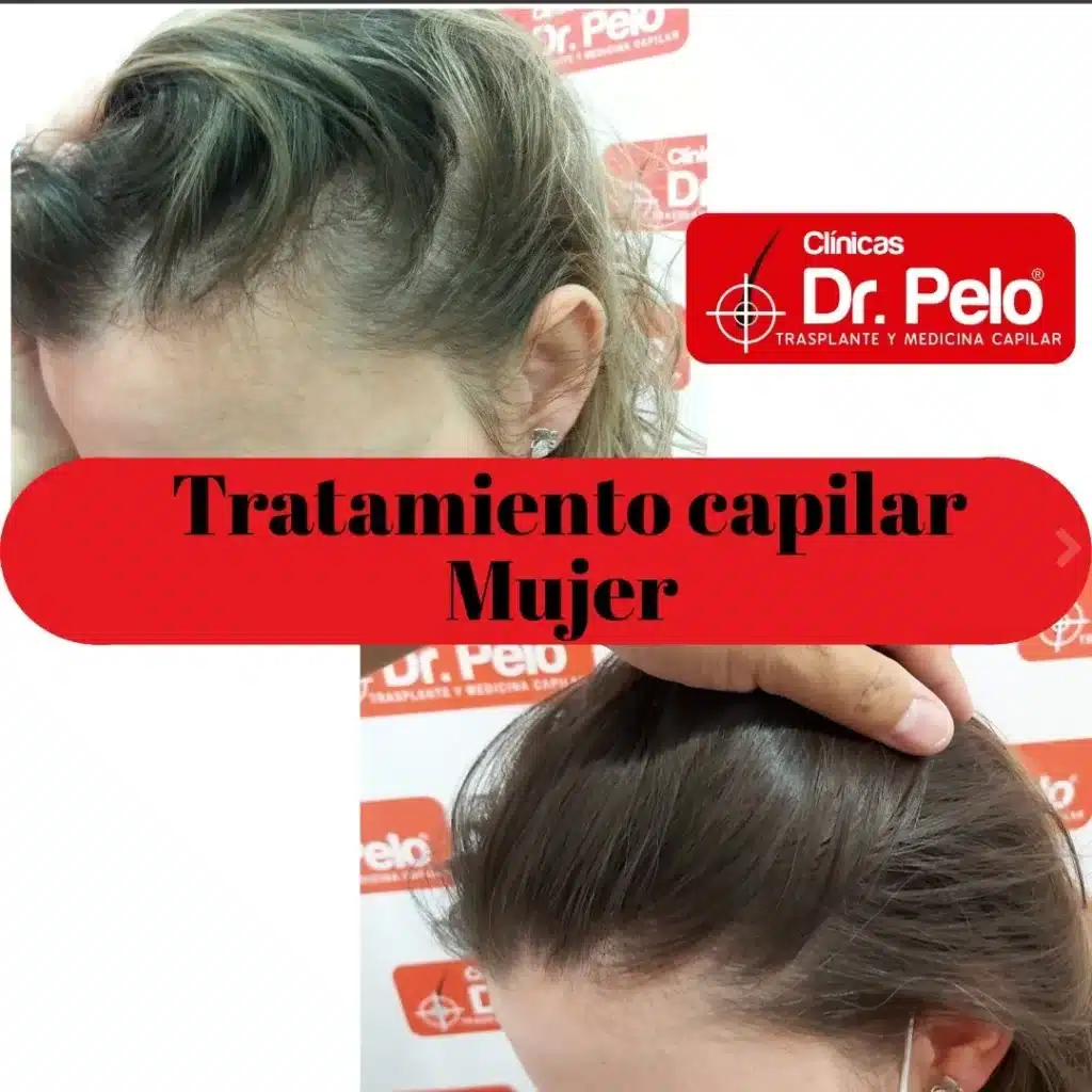 TRATAMIENTO-CAPILAR-MUJER